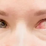 قرمزی چشم چیست ؟ 10 علت قرمزی چشم و راه های درمان آنها