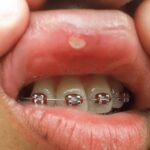 آیا ارتودنسی میتواند باعث آفت دهان شود؟
